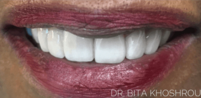 Isabella Smile Transformation - After