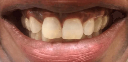 Isabella Smile Transformation - Before