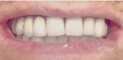 Jonathan Smile Transformation - Before