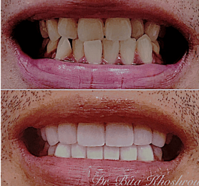 Trance Smile Transformation - Before