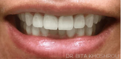 Erica Smile Transformation - After