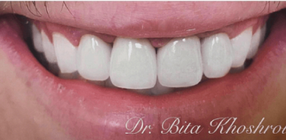 Hugo Smile Transformation - After