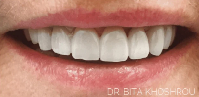 Stacy Smile Transformation - After