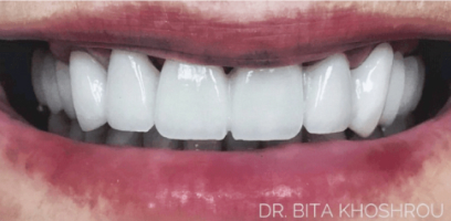 Karen Smile Transformation - Before