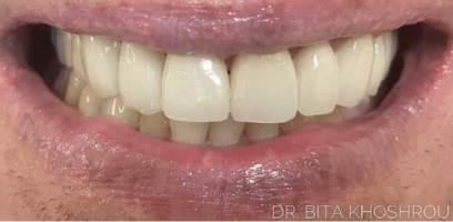 Ethan Andrew' Smile Transformation - After