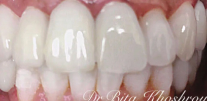 Emma Smile Transformation - After