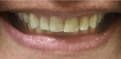 Kenneth Smile Transformation - Before