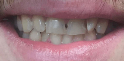 Hugo Smile Transformation - Before