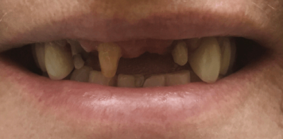 Stacy Smile Transformation - Before