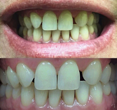JuliaSmile Transformation - Before