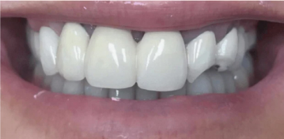Karen Smile Transformation - Before