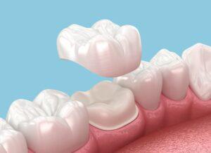 How Much Do Dental Crowns Cost in Florida?