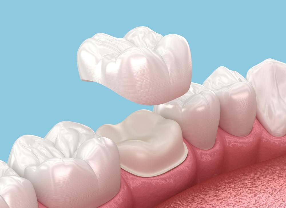 The image depicts a dental crown being placed. How much do dental crowns cost in Florida?