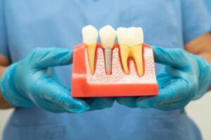 What Makes Someone a Good Candidate for Dental Implants?