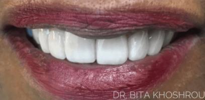 Close-up of a person smiling with white teeth and maroon lipstick. The text "DR. BITA KHOSHROU" appears at the bottom right.