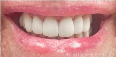 A close-up of a person's mouth showing upper and lower teeth, with the lips slightly parted in a smile.