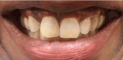 Close-up of a person's mouth showing teeth and gums, with noticeable gum discoloration and slightly uneven front teeth.