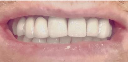 Close-up of a person's mouth showing upper and lower teeth, with the teeth appearing unnaturally white and even, suggesting dental veneers or cosmetic work.