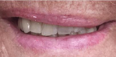 Close-up of a person's mouth with slightly parted lips, revealing upper and lower teeth. The skin around the lips appears textured.