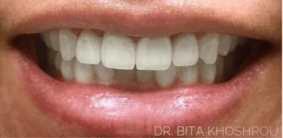 A close-up of a person's mouth showing their upper and lower teeth as they smile. The teeth appear clean and well-aligned.