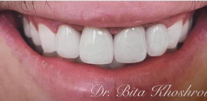 Close-up of a person's mouth smiling, showing clean, white teeth. The name "Dr. Bita Khoshroo" is visible in the lower right corner.