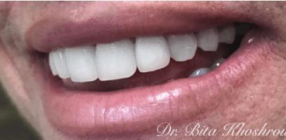 A close-up of a person's mouth showing white, straight teeth with a missing tooth toward the back.