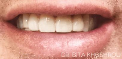 Close-up of a person's mouth showing upper and lower teeth, with the name "DR. BITA KHOSHROU" visible in the bottom right corner.