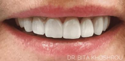 A close-up of a person's mouth showing straight, white teeth and pink lips. The text "DR. BITA KHOSHROU" appears in the lower right corner.