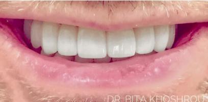 Close-up of a person's mouth showing straight, white teeth and light facial hair.