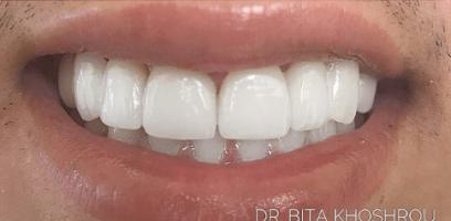 A close-up of a person's mouth smiling with bright white, evenly aligned teeth.