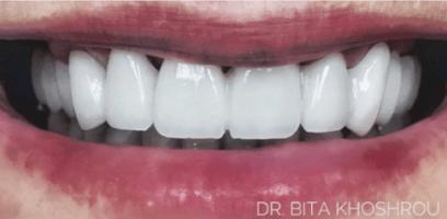 Close-up of a person's mouth showing a set of bright white dental veneers or crowns on the upper teeth.