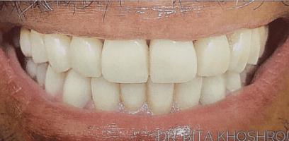 Close-up of a person's mouth showing clean, aligned upper and lower teeth in a smile.