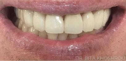 Close-up of a person's mouth showing upper and lower teeth, lips slightly parted, with dental veneers or crowns visible.