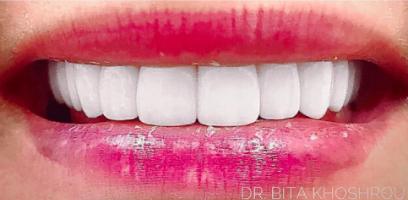 Close-up of a person's mouth showing white, even teeth and lips with faded pink lipstick.