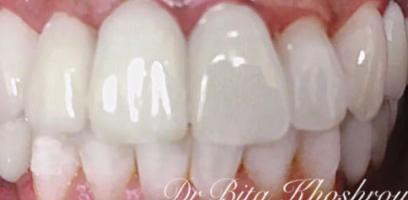 A close-up of upper and lower teeth, with some teeth appearing whiter and larger, possibly indicating dental crowns or veneers.