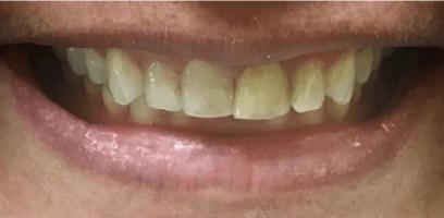 Close-up of a person's mouth showing slightly yellowed teeth and a neutral expression.
