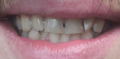 A close-up of a person's mouth showing slightly parted lips and upper front teeth with visible gaps and uneven edges.