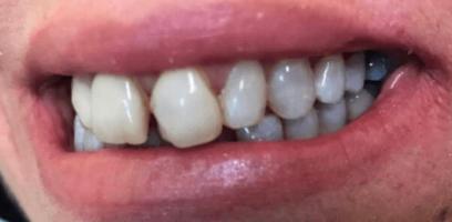 Close-up of a person's mouth showing upper front teeth, with some teeth appearing yellowed and others grayish in color.