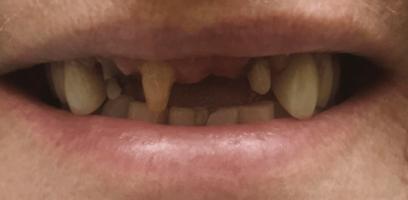 A close-up of a person's mouth showing several missing or broken upper teeth and significant tooth discoloration.