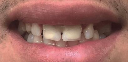 A close-up of a person's mouth showing upper front teeth with visible gaps and slightly uneven alignment.