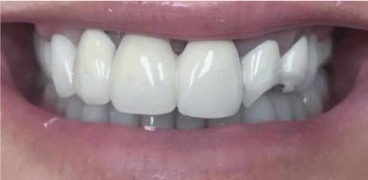 A close-up of a person's smile showing upper front teeth, with one tooth appearing chipped and misaligned.