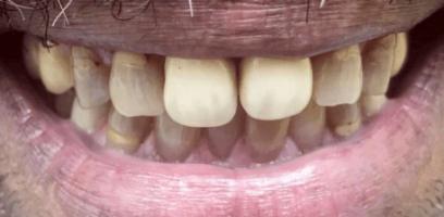 Close-up of a person's mouth showing yellowed, uneven teeth with visible discoloration and plaque buildup.