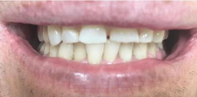 Close-up of a person's mouth showing upper and lower teeth, with a small gap between the top front teeth.