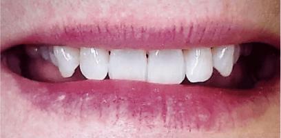 A close-up of a person's mouth, showing their upper and lower teeth with lips slightly parted.