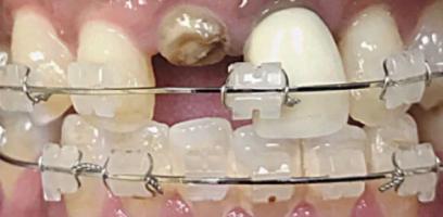 Close-up of teeth with ceramic braces; one upper tooth shows severe decay near the gum line.